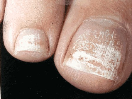 Witte vlekjes in de nagel – Leukonychia